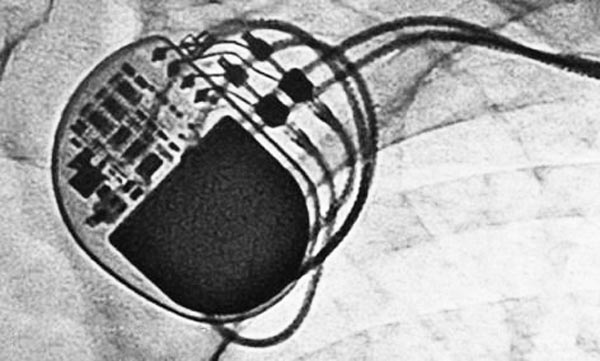 激光焊接在醫(yī)療行業(yè)技術中的應用(圖2)